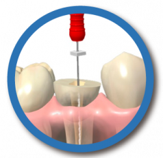 gallery/endodoncia
